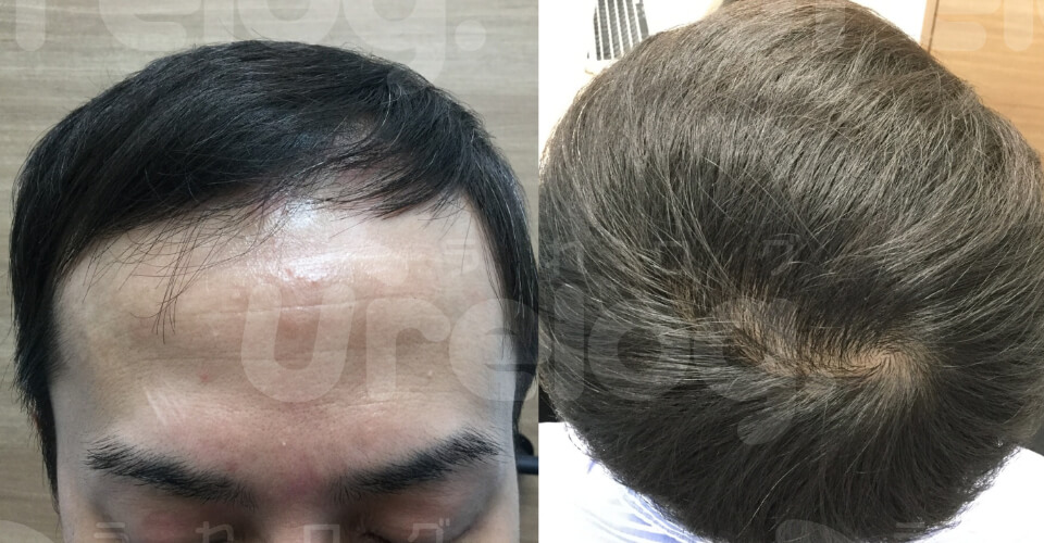 AGA治療0ヶ月目の頭髪写真[正面・頭頂部]